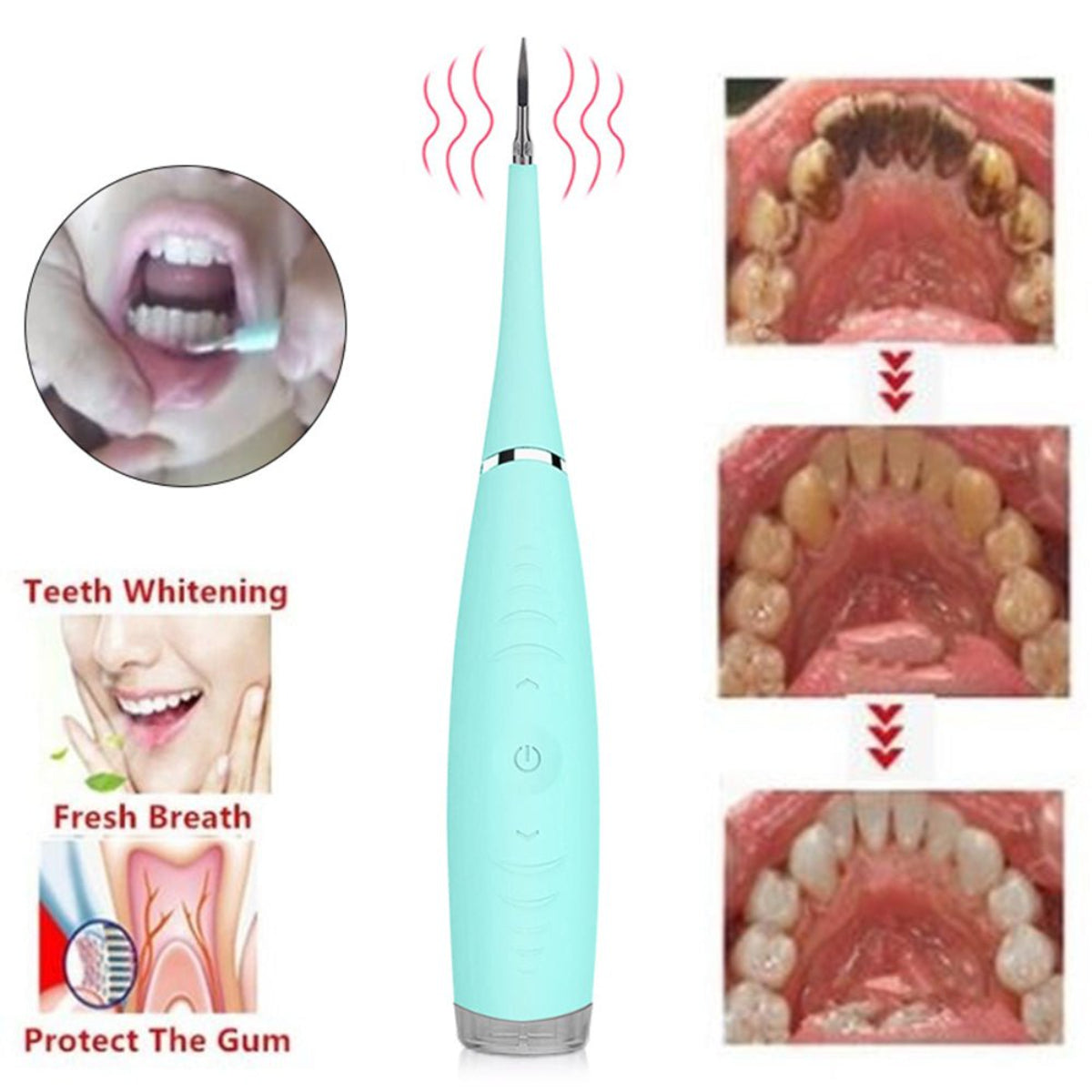 UltraSonic Dental Calculus Remover